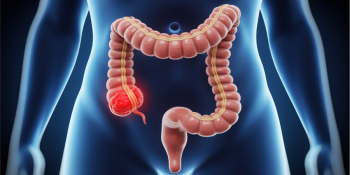 O câncer que matou Preta Gil pode estar se formando no seu intestino agora